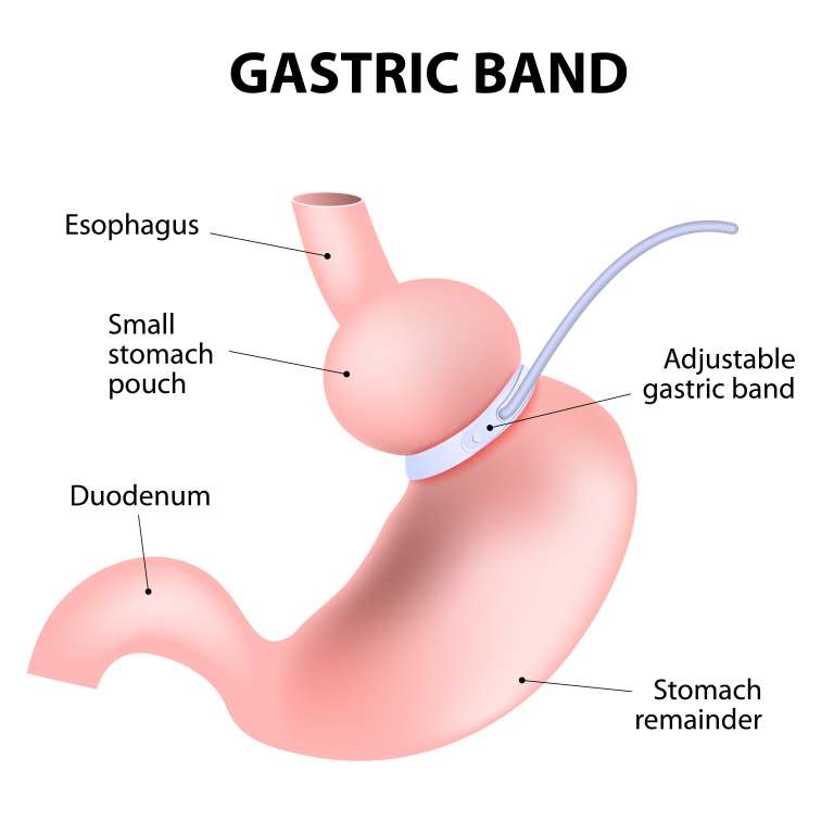 Frequently Asked Questions: Virtual Gastric Band Hypnotherapy